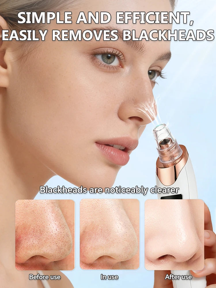 powerful blackhead removed